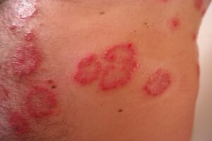 skin with psoriasis patches